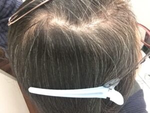 ar髪-アラカミ-利尻カラーシャンプーを使わなくなって約3週間目。頭頂部から10センチ15センチは、はっきりと白髪の色に戻ってしまっています。