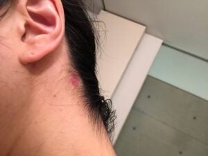 ar髪-アラカミ-市販のシャンプーを1週間ほど使った時に出てきた湿疹（赤い部分）皮膚が剥がれてじくじくしています。