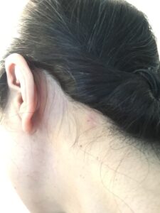 ar髪-アラカミ-カダソンシャンプーを使い始めて2週間目ごろの脂漏性皮膚炎の状態！！