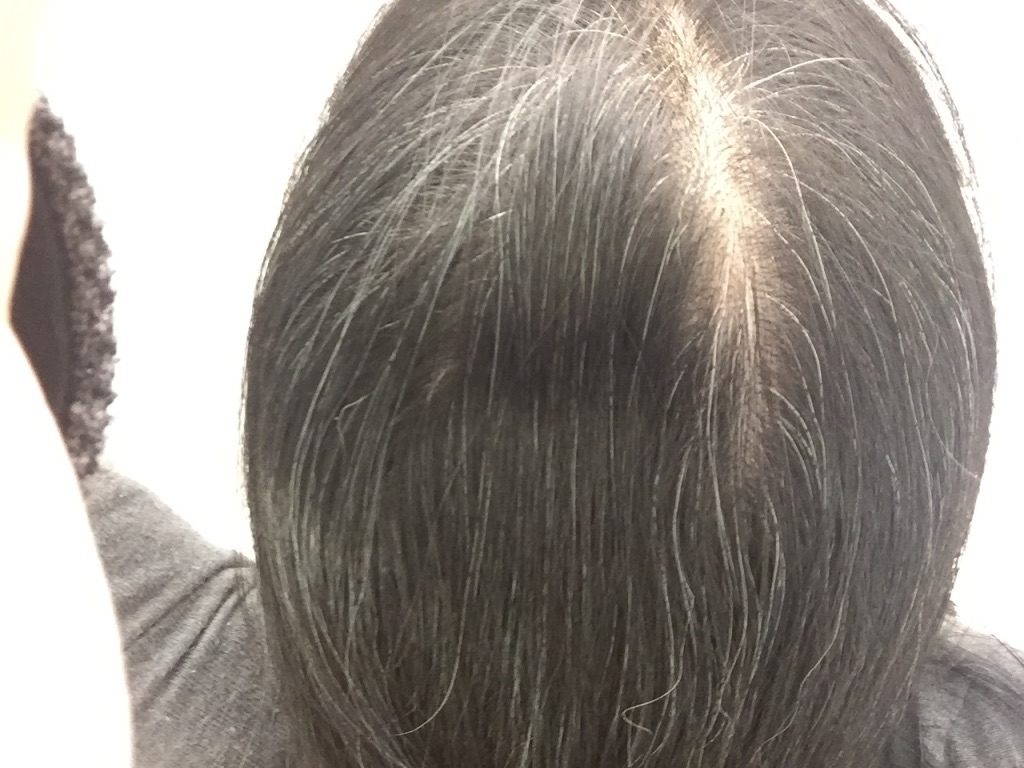 ar髪-アラカミ-薄毛も気になる41歳の白髪